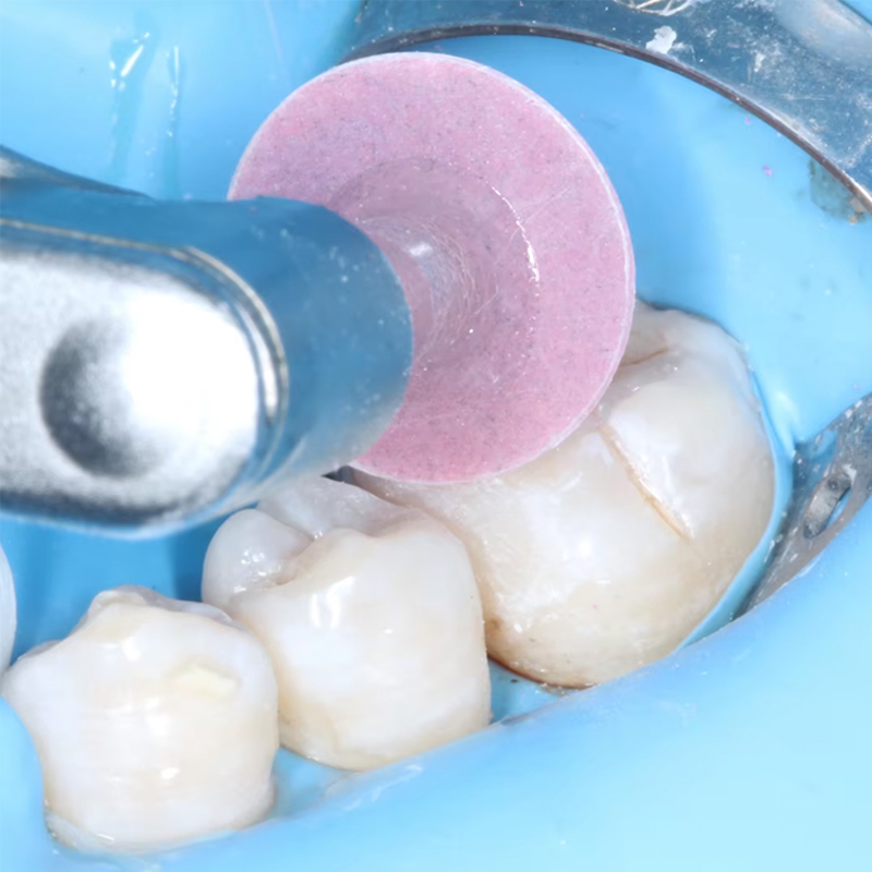 40Pcs Dental Polishing Disc Co - Teeth Whitening Home ulasan dan harga