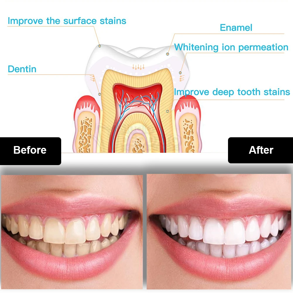 Dental Teeth Whitening Kit Min - Teeth Whitening Q&M ulasan dan harga